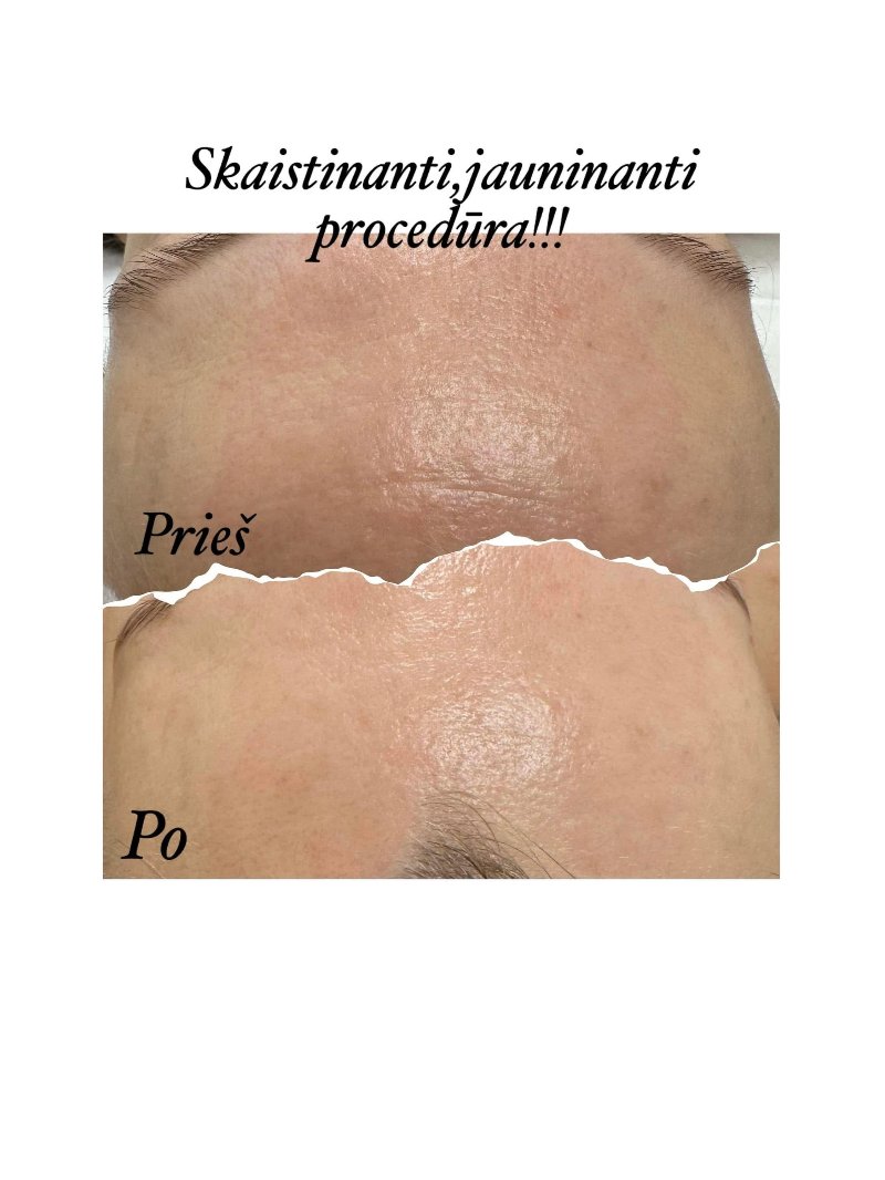 Odos rezultatas prieš ir po procedūros 12