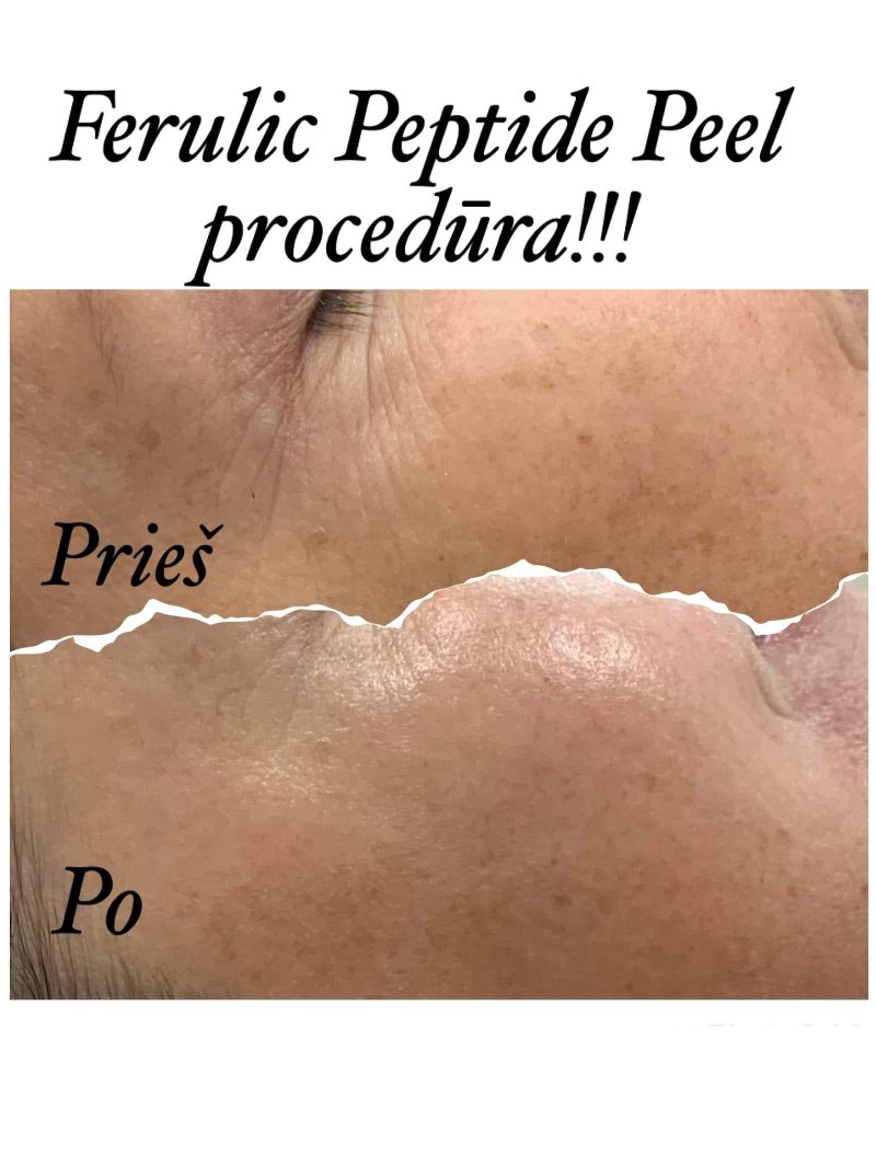 Odos būklė prieš ir po procedūros