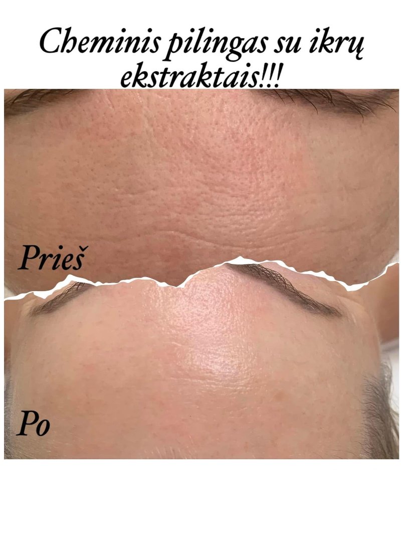 Odos rezultatas prieš ir po procedūros 4