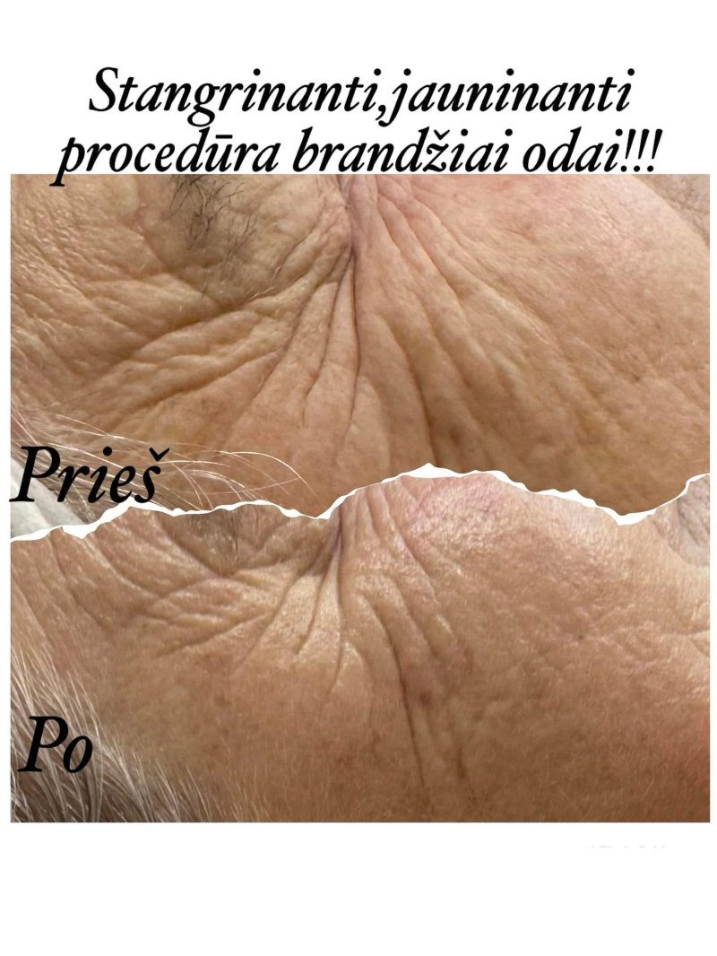 Odos būklė prieš ir po procedūros