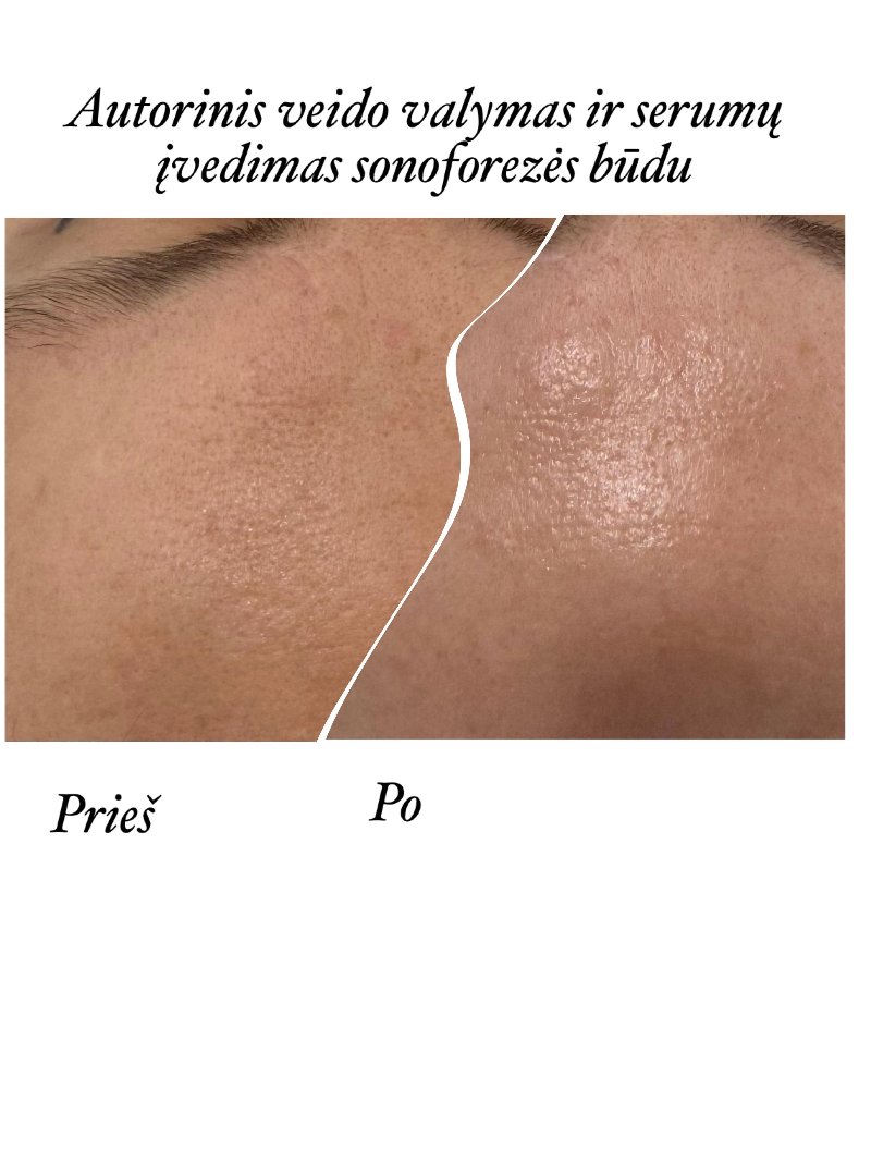 Odos rezultatas prieš ir po procedūros 7
