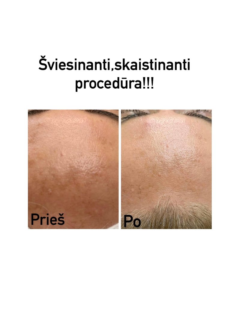 Odos būklė prieš ir po procedūros